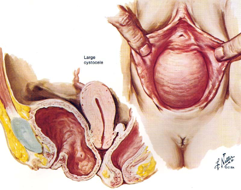 Bladder problems clearance in women
